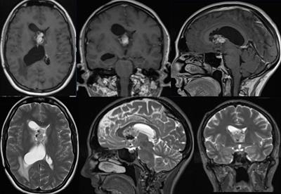 Case report: ‘Photodynamics of Subependymal Giant Cell Astrocytoma with 5-Aminolevulinic acid’